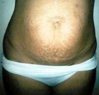 Tummy tuck to get rid of stretch marks image
