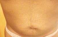 Tummy tuck to get rid of stretch marks surgery