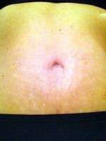 Tummy tuck to remove stretch marks images
