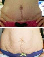 Tummy tuck with c section before and after