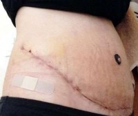 Tummy tuck without drains photo