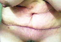 Tummy tuck without drains question