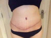 Tummy tucks scars image