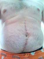 Umbilical hernia and tummy tuck for man