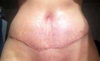 Upper abdominal swelling after abdominoplasty