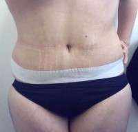 Upper abdominal swelling after tummy tuck operation