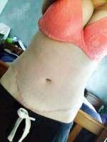 Upper abdominal swelling after tummy tuck surgery