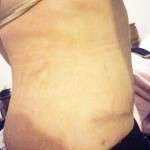 Upper abdominal swelling of scar after tummy tuck