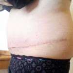 Upper abdominal swelling scar after tummy tuck