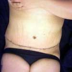 Upper abdominal swelling scar after tummy tuck operation