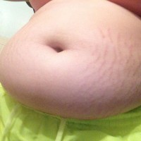 Visceral fat removal surgery picture