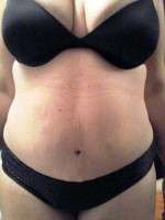 Weight loss after abdominoplasty surgery