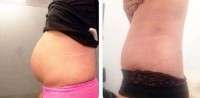 Weight loss after tummy tuck and liposuction before and after