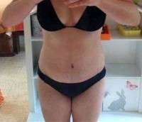 Weight loss after tummy tuck surgery photo