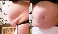Weight loss from tummy tuck before