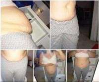 Weight loss from tummy tuck picture