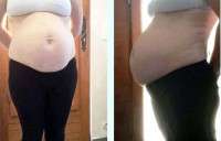 Weight loss with abdominoplasty