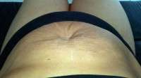 Weight loss with tummy tuck photo