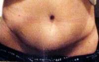 What is a seroma after tummy tuck operation