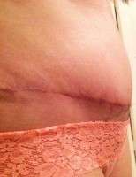 What is a seroma after tummy tuck photo
