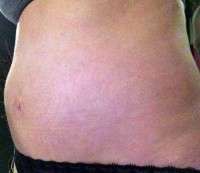 What is a seroma after tummy tuck photos