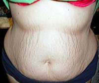 What is involved in a tummy tuck procedure question