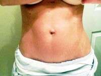 What is the tummy tuck procedure