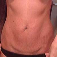 What is tummy tuck surgery procedure