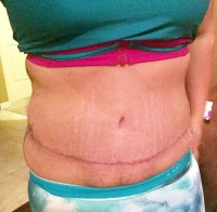When can i go back to work after tummy tuck surgery