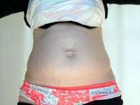 When do you need a tummy tuck question