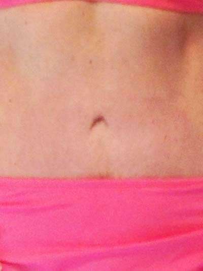 before and after tummy tuck with stretch marks