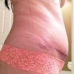abdominal swelling after tummy tuck