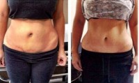 before and after mesotherapy tummy tuck