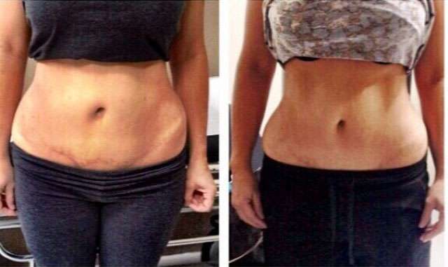 before after mini tummy tuck