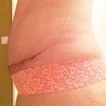 how long does tummy tuck swelling last