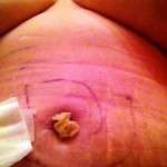 how long will swelling last after tummy tuck