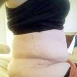 how to reduce tummy tuck swelling