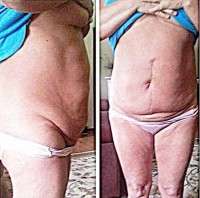 medical reasons for abdominoplasty