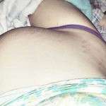 pregnancy after abdominoplasty photos (1)