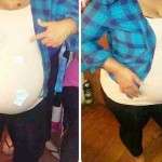 pregnancy after tummy tuck operation photos (1)