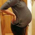 pregnancy after tummy tuck surgery photos (4)