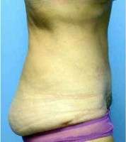 tummy tuck incision images
