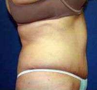 tummy tuck incision pictures