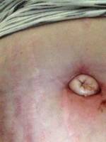 A belly button after tummy tuck