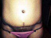 A tummy tuck after pictures