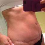 A tummy tuck after pictures of patient