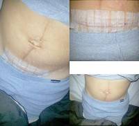 A tummy tuck post c section