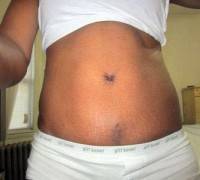A tummy tuck weight