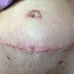 Abdominoplasty after picture