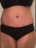 Abdominoplasty after pictures